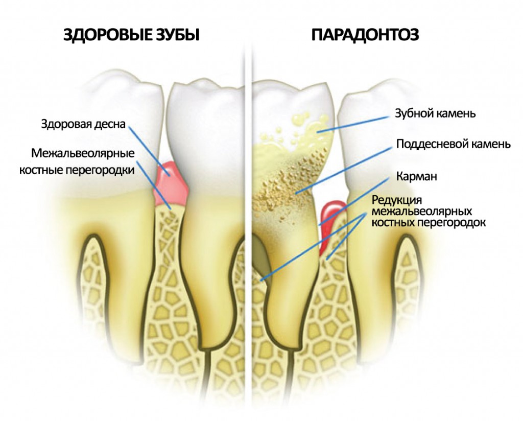 Пародонтит