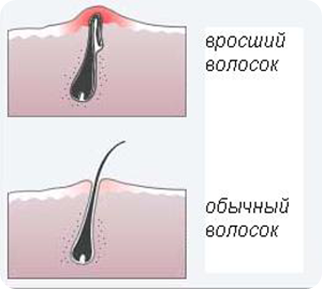 Как избавиться от вросших волос